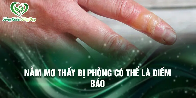 Nằm Mơ Thấy Bị Phỏng: Ý Nghĩa Và Cơ Hội Ẩn Giấu 2 Nằm mơ thấy bị phỏng có thể là điềm báo