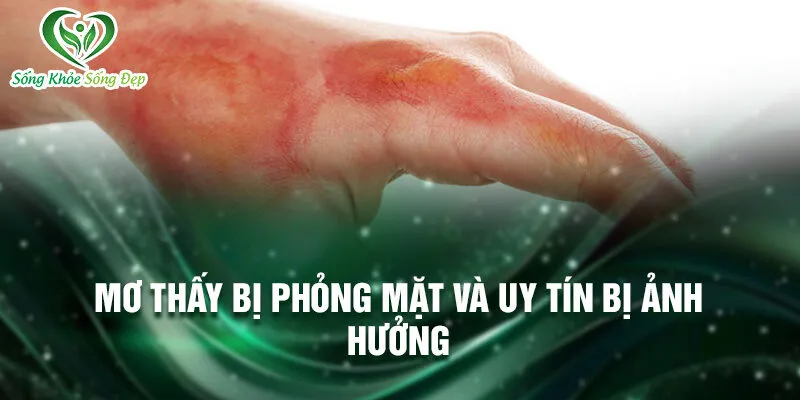 Nằm Mơ Thấy Bị Phỏng: Ý Nghĩa Và Cơ Hội Ẩn Giấu 3 Mơ thấy bị phỏng mặt và uy tín bị ảnh hưởng