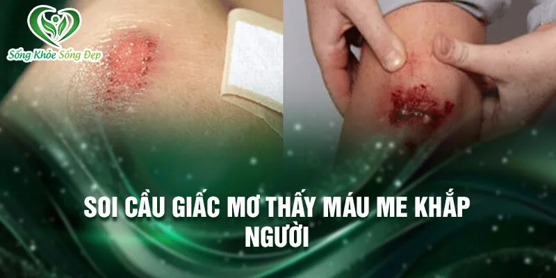 Nằm Mơ Thấy Máu Me Khắp Người: Bí Ẩn Và Giải Đáp 3 Soi cầu giấc mơ thấy máu me khắp người