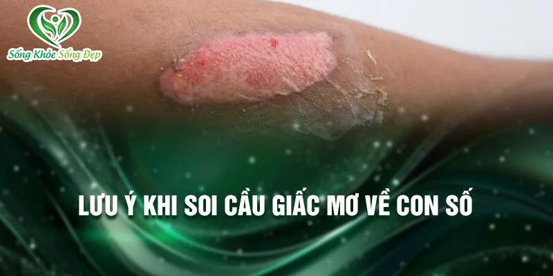 Nằm Mơ Thấy Bị Phỏng: Ý Nghĩa Và Cơ Hội Ẩn Giấu 4 Lưu ý khi soi cầu giấc mơ về con số